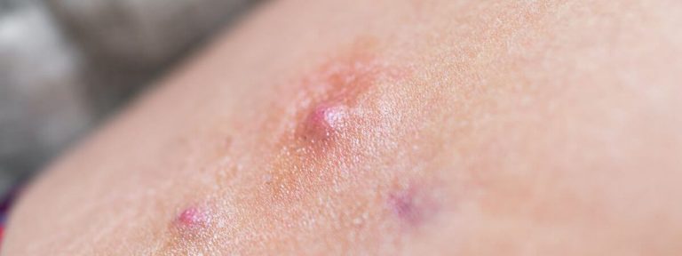 Furoncle : solutions naturelles pour apaiser et prévenir